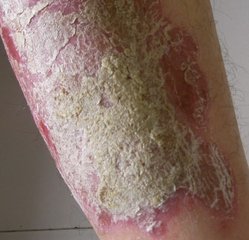 牛皮癣患者的饮食中有哪些是不能吃的