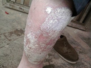 患者要怎么做好牛皮癣的护理工作