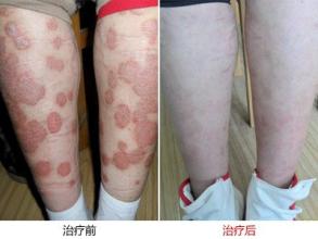 牛皮癣可以通过血液来进行传染吗